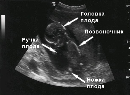 УЗИ на 14 неделе беременности