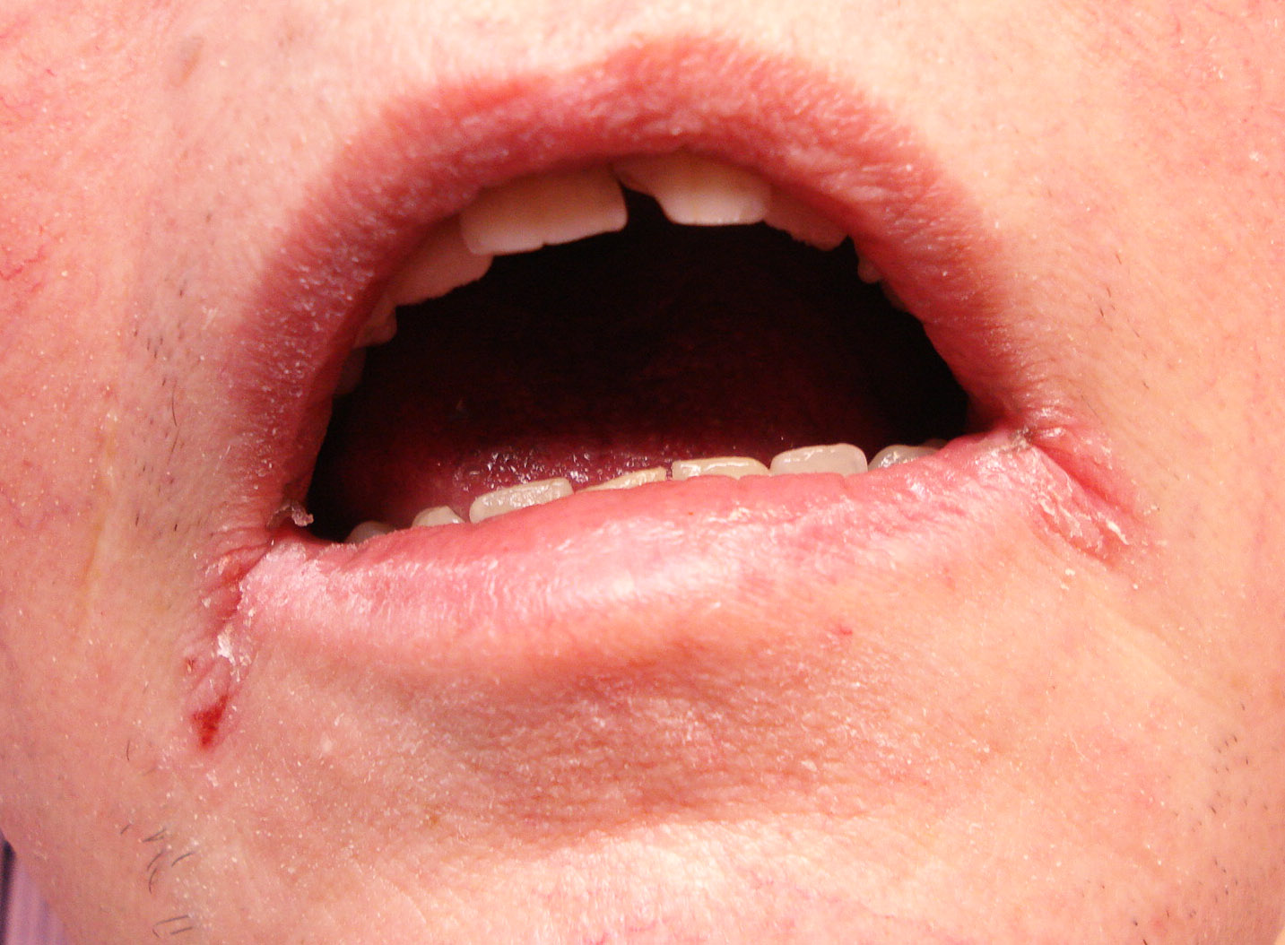 Хейлит на губах: симптомы и как лечить правильно