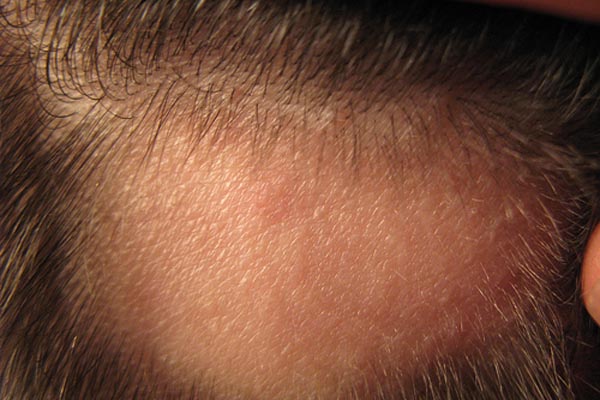 лечение лысины на голове у мужчин медицинскими средствами