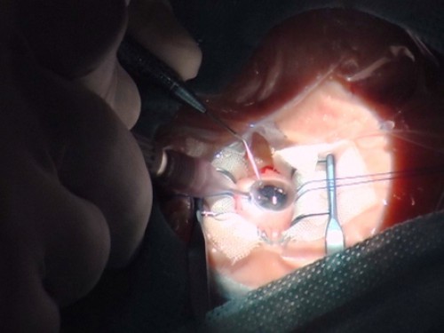 Глаз пациента в процессе операции