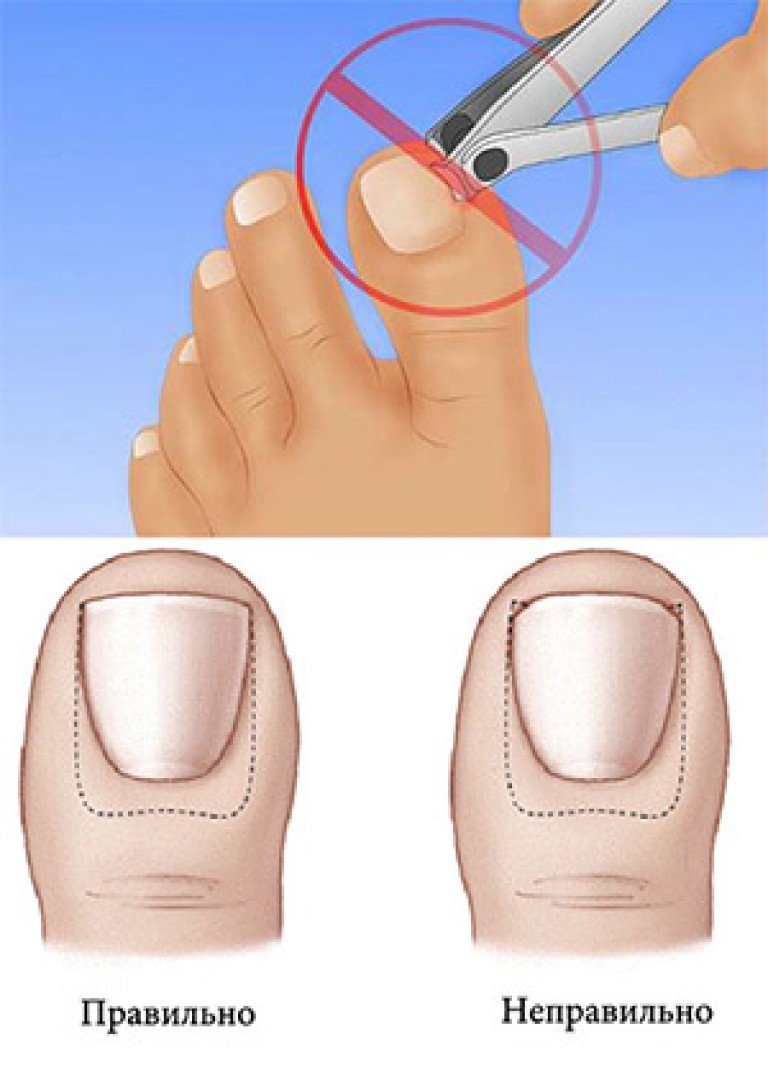 Ноготь врос в палец на ноге: причины и быстрое лечение