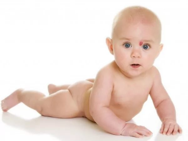Гемангиома у новорожденных причины возникновения и лечение