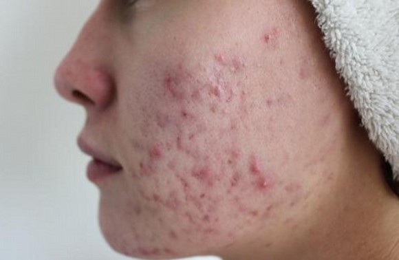 Демодекоз на лице у женщин: фото, лечение