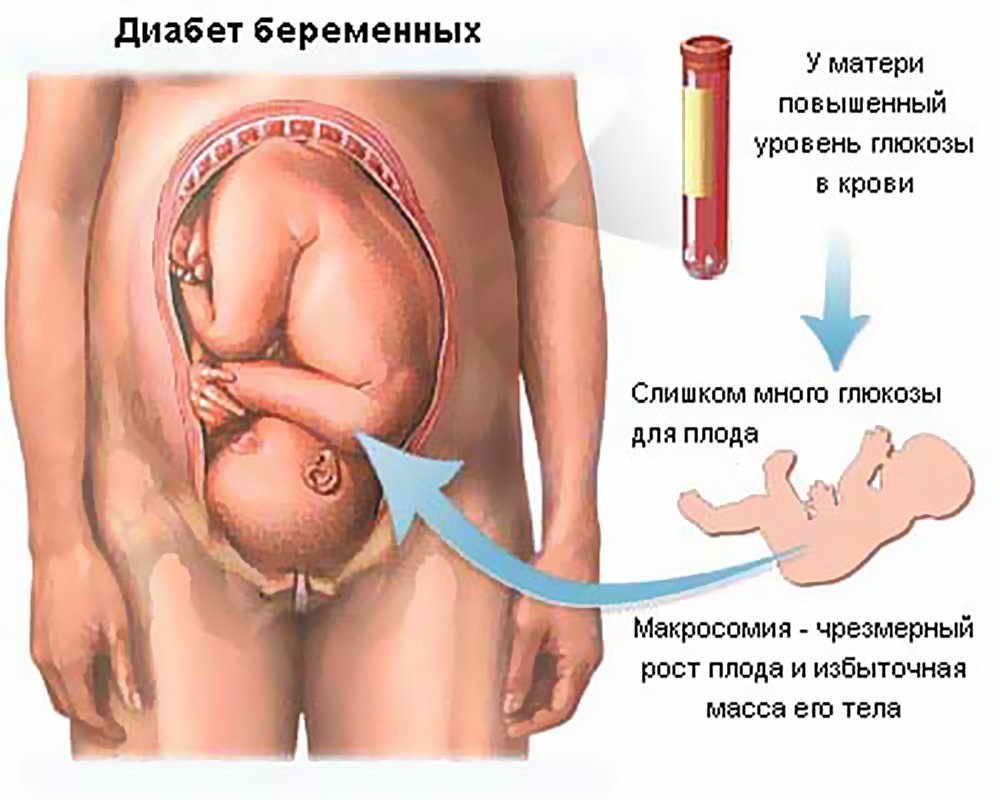Диабет при беременности последствия