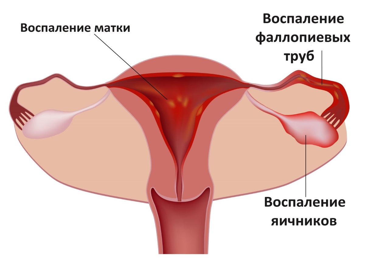 Воспаление яичника у женщин: причины, симптомы и лечение