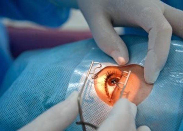 Операция при заболевании глаза 