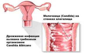 молочница на стенках влагалища при беременности