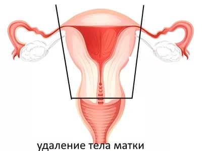 Выпадение матки у женщин пожилого возраста: симптомы и лечение