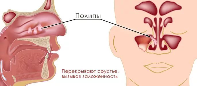 Полипы в носу у взрослых: фото, симптомы и лечение