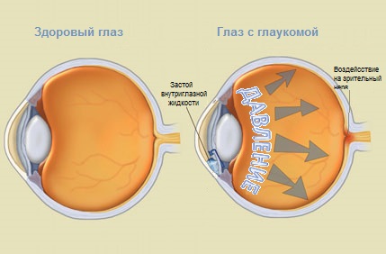 Разница между здоровым и больным глазом 