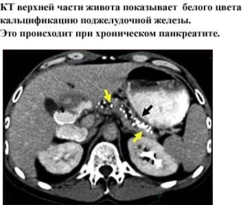 Диагностика панкреатита у детей - компьютерная томография