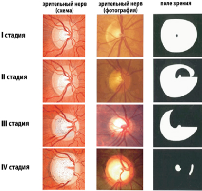 I, II, iii и IV стадии глаукомы 