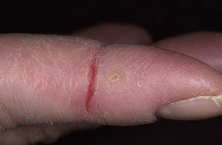 Почему трескается кожа на пальцах рук: причины, лечение, симптомы