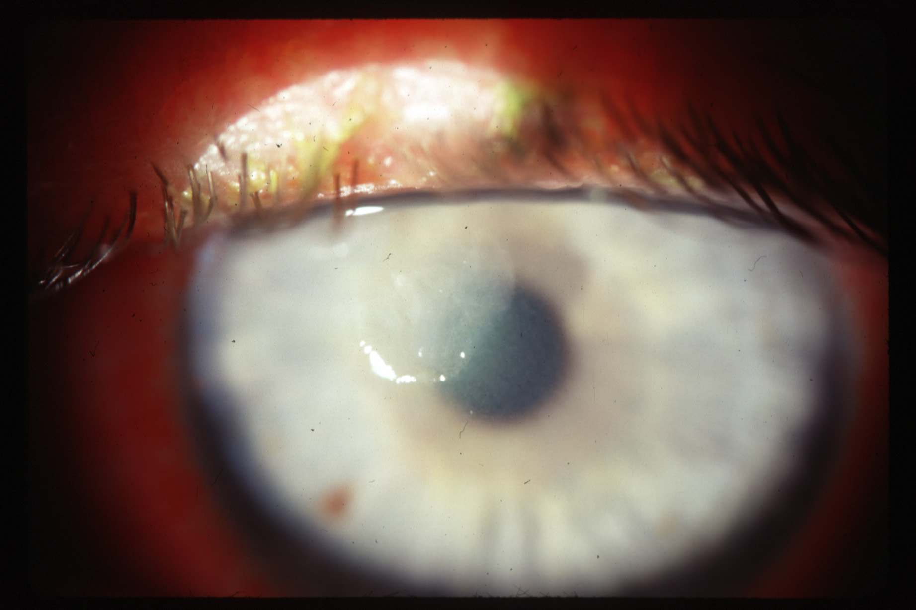 Поверхностный кератит глаза: симптомы и лечение