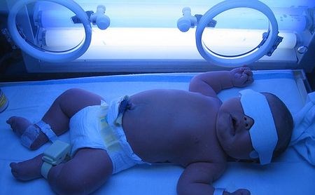 фототерапия новорожденных при желтухе