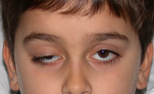 Амблиопия (ленивый глаз): симптомы и причины появления