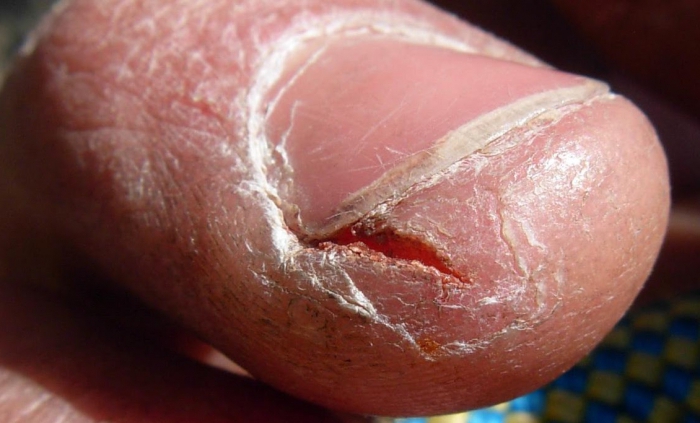 Почему трескается кожа на пальцах рук: причины, лечение, симптомы