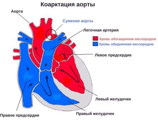 Коарктация аорты в рожденный порок сердца у новорожденных