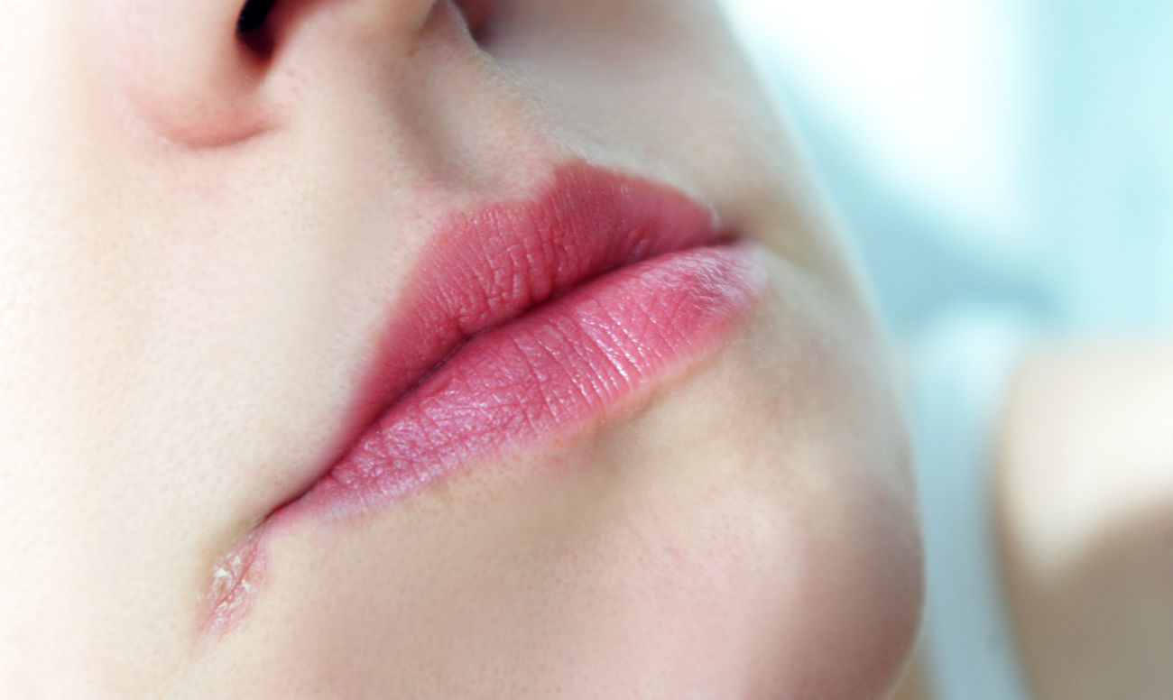 Заеды на губах: причины и как лечить народными средствами