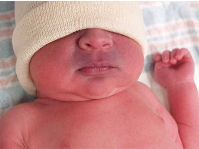 Цианоза у новорожденных