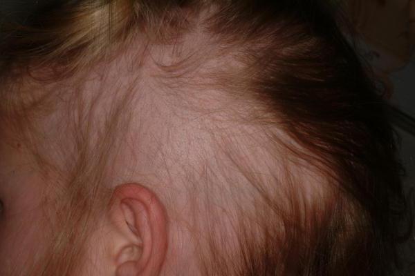 первые причины выпадения волос у детей