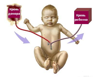 Переливание крови новорожденным при желтухе