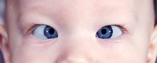 Амблиопия (ленивый глаз) у детей: симптомы, диагностика, лечение