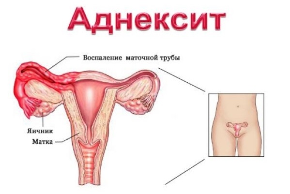 Хронический аднексит: симптомы и лечение у женщин