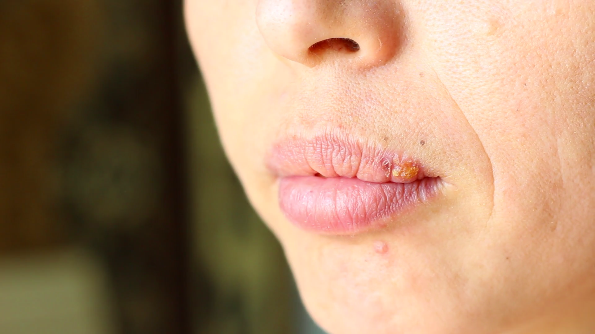 Как и чем быстро лечить герпес на губах