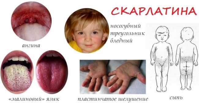 Симптомы скарлатины у детей