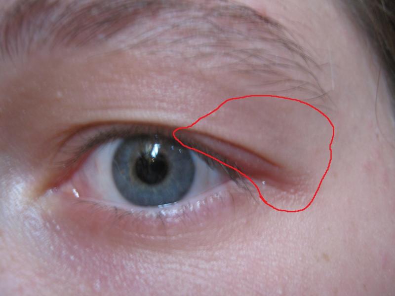 Опухло веко над глазом и болит: причины и быстрое лечение