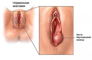 Варикозное расширение половых губ