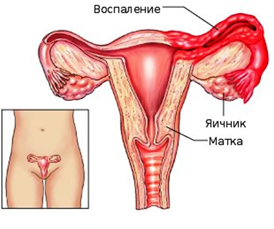 Воспаление яичника у женщин: причины, симптомы и лечение