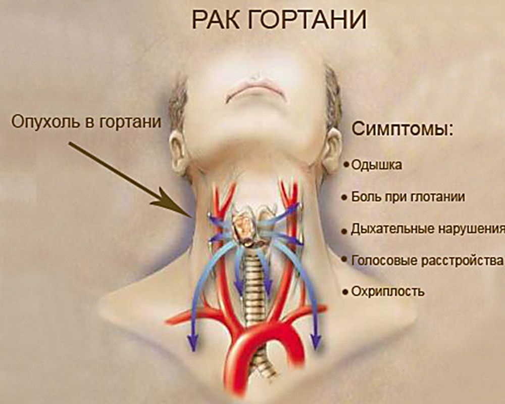 Заболевания горла и гортани: симптомы, лечение, название болезней