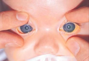Больные глаза новорожденного 