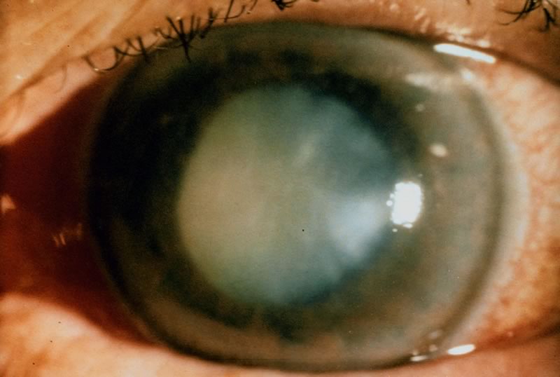 Так выглядит глаз с глаукомой 4 стадии 