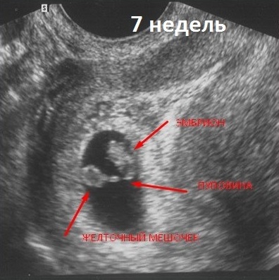 Фото плода на 5 неделе беременности по узи