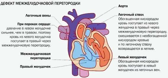 Дефект межжелудочковой перегородки врожденный порок сердца у новорожденного