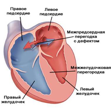 Дефект межпредсердной перегородки врожденный порок сердца у новорожденного