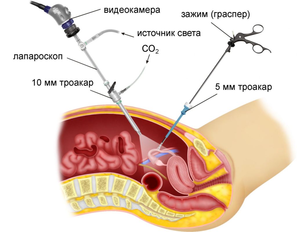 laparoskopiya