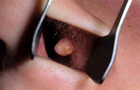 Полипы в носу у взрослых: фото, симптомы и лечение