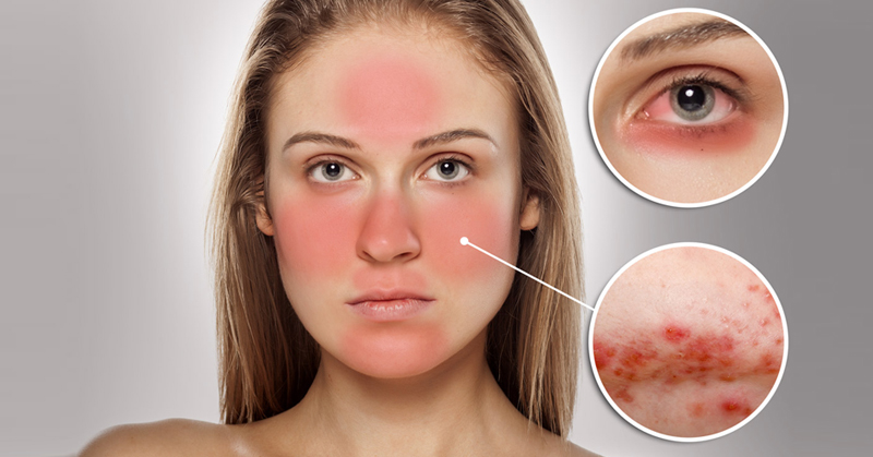 Демодекоз на лице у женщин: фото, лечение