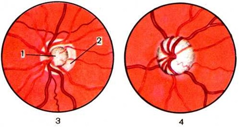 Физиологическое углубление диска зрительного нерва