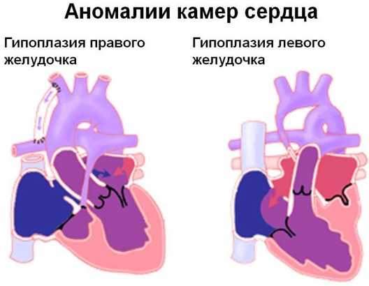 Гипоплазия левого сердца врожденный порок сердца у новорожденного