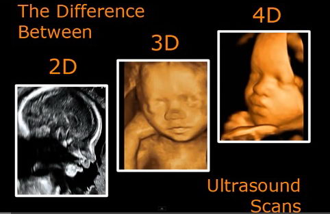 что такое доплер беременных 2D, 3D или 4D