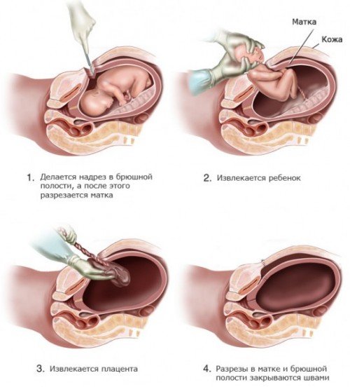 Проведение операции кесарево сечение