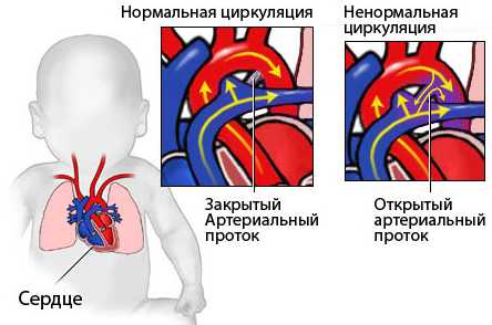 Артериальный проток врожденный порок сердца у новорожденных