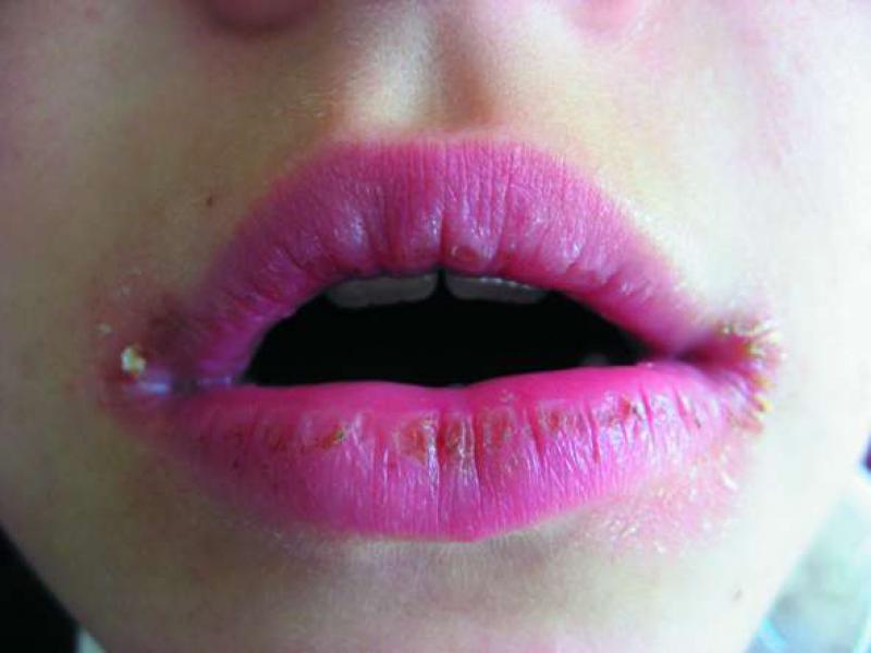 Хейлит на губах: симптомы и как лечить правильно