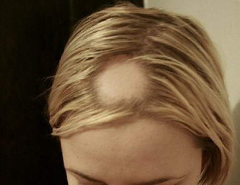 Выпадение волос кругами на голове у женщин