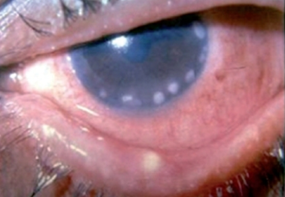 Краевой (лимбальный) кератит глаза: симптомы, причины, лечение и профилактика